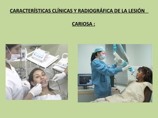 CARACTERÍSTICAS CLÍNICAS Y RADIOGRÁFICA DE LA LESIÓN

                       CARIOSA :
 
