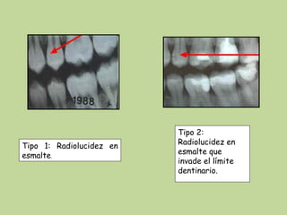 Tipo 2:
Tipo 1: Radiolucidez en   Radiolucidez en
esmalte.                  esmalte que
                          invade el límite
                          dentinario.
 