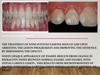 CARIES INFILTRATION THEORY :
THE TREATMENT OF NONCAVITATED LESIONS SHOULD AIM UPON
ARRESTING THE LESION PROGRESSION AND IMPROVING THE ESTHETICS
BY DIMINISHING THE OPACITY .
WHITE OPAQUE APPEARANCE OF ENAMEL RESULTS FROM CHANGE IN
REFRACTIVE INDEX BETWEEN NORMAL ENAMEL AND ENAMEL WITH
INITIAL CARIOUS LESION , THIS RESULTS FROM MICROPOROSITIES OF
ENAMEL WITH INITIAL CARIOUS LESION WHICH CAUSES SCATTERING OF
LIGHT .
 