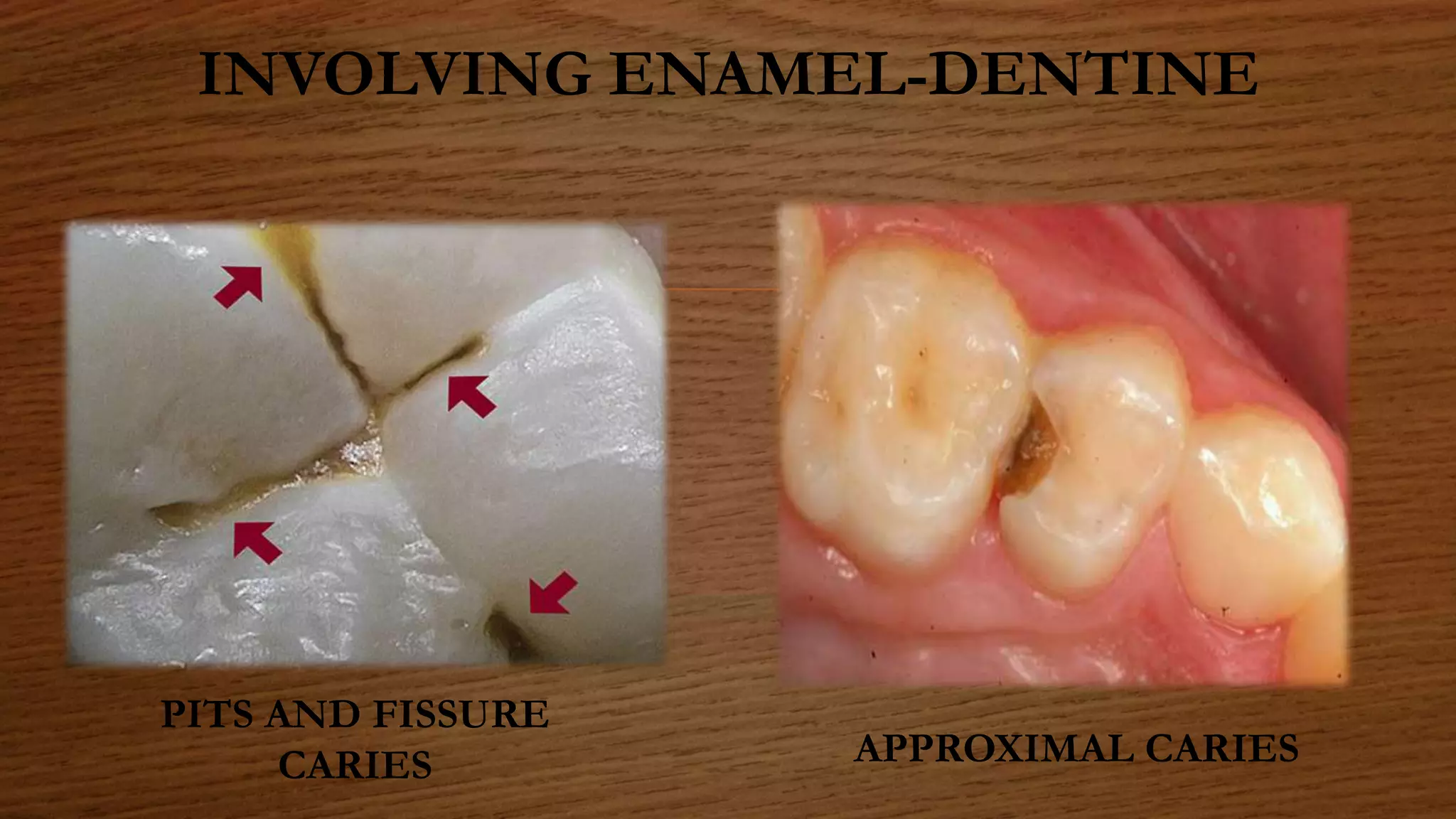 INVOLVING ENAMEL-DENTINE
PITS AND FISSURE
CARIES APPROXIMAL CARIES
 