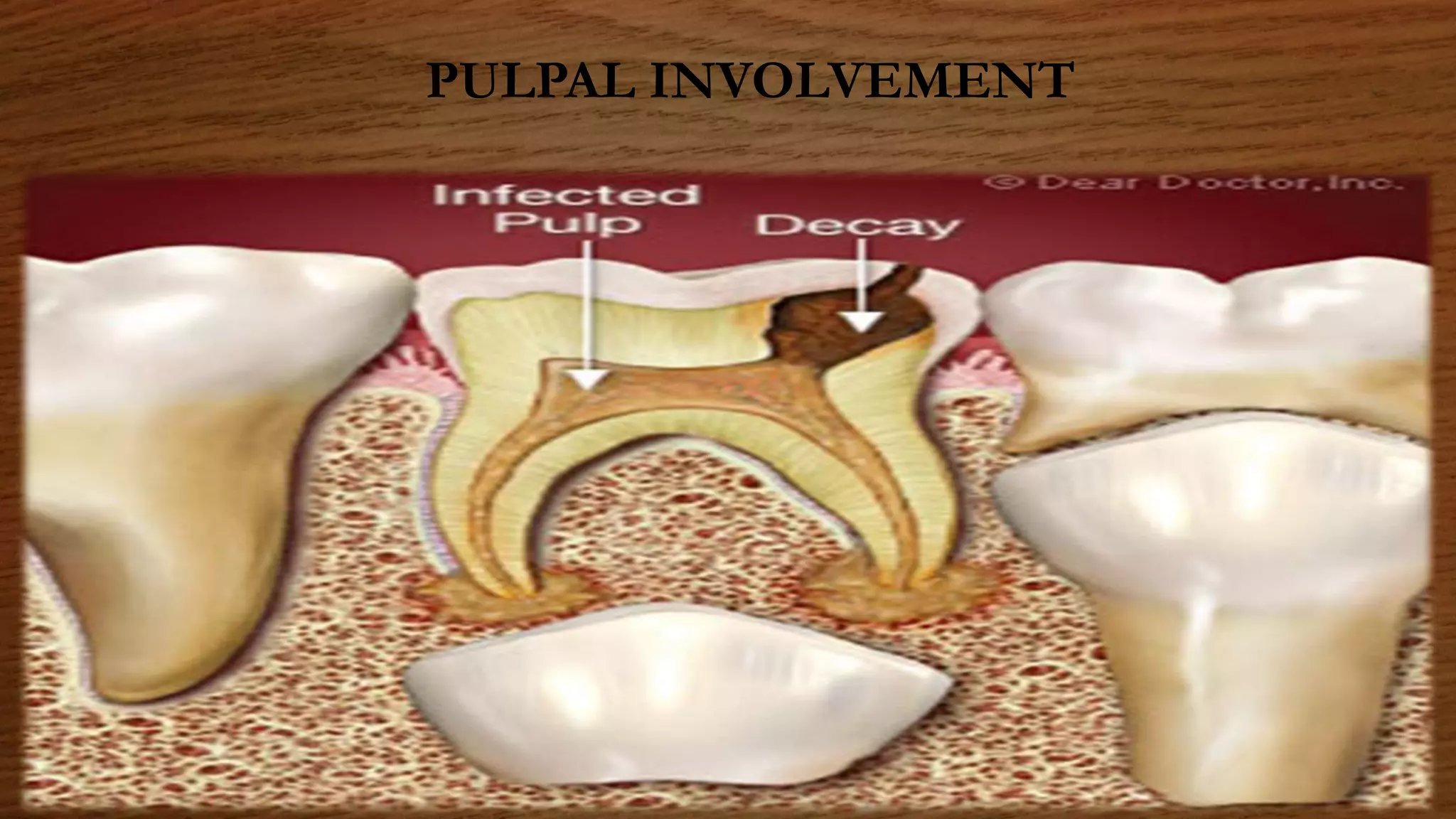 PULPAL INVOLVEMENT
 