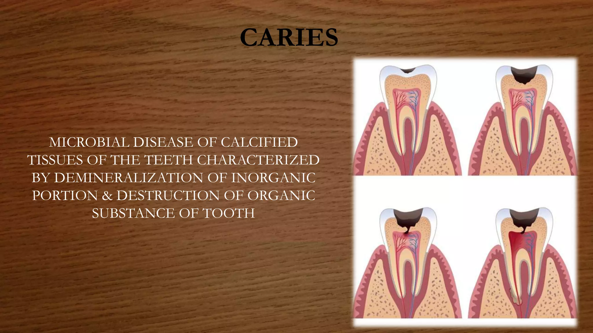CARIES
MICROBIAL DISEASE OF CALCIFIED
TISSUES OF THE TEETH CHARACTERIZED
BY DEMINERALIZATION OF INORGANIC
PORTION & DESTRUCTION OF ORGANIC
SUBSTANCE OF TOOTH
 