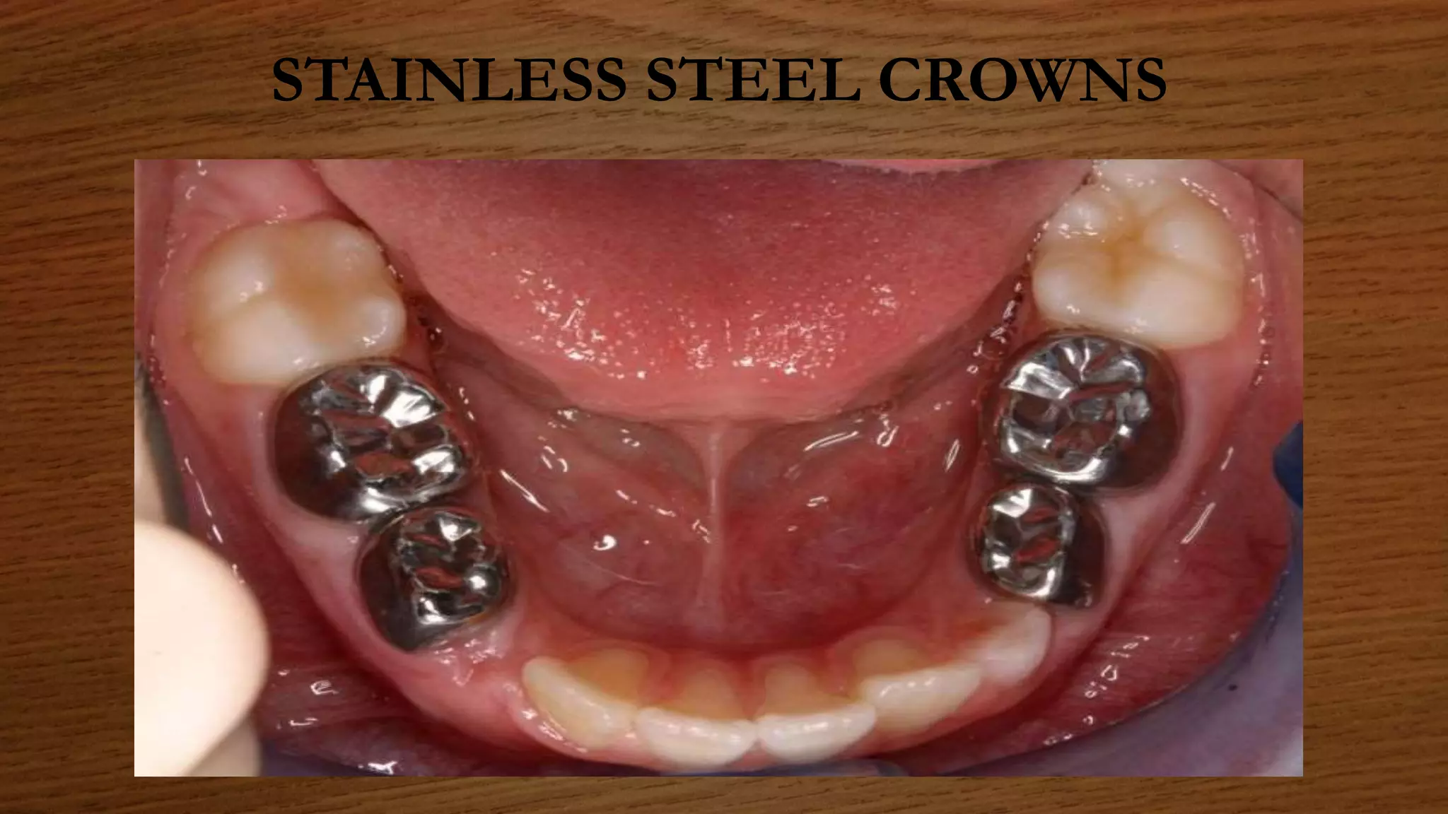 STAINLESS STEEL CROWNS
 
