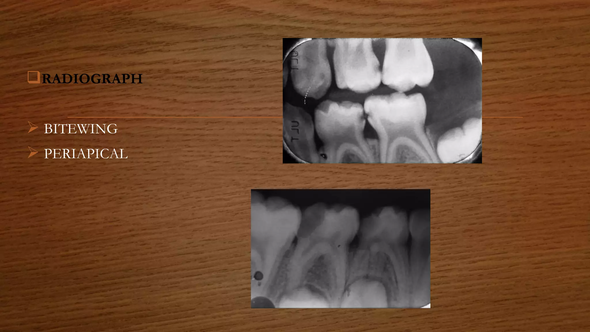 RADIOGRAPH
 BITEWING
 PERIAPICAL
 