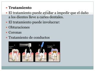  Tratamiento
 El tratamiento puede ayudar a impedir que el daño






a los dientes lleve a caries dentales.
El tratamiento puede involucrar:
Obturaciones
Coronas
Tratamiento de conductos

 