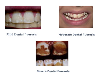 Mild Dental fluorosis Moderate Dental fluorosis
Severe Dental fluorosis
 