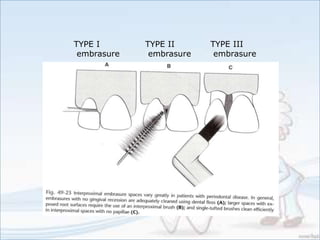 TYPE I
embrasure
TYPE II
embrasure
TYPE III
embrasure
 