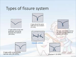 Types of fissure system
U type almost the same
width from top to bottom
(12-15%)
V type-wide at top and
gradually narrowing
towards the bottom.
(30-35%)
IK type, extremely narrow
slit with a larger space at
bottom.(24-26%)
I type with a extremely
narrow slit.(18-20%) Inverted Y. (5-10%)
FISSURE SYSTEM
 