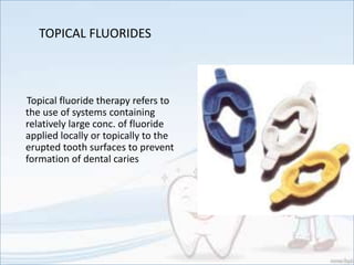 TOPICAL FLUORIDES
Topical fluoride therapy refers to
the use of systems containing
relatively large conc. of fluoride
applied locally or topically to the
erupted tooth surfaces to prevent
formation of dental caries
 