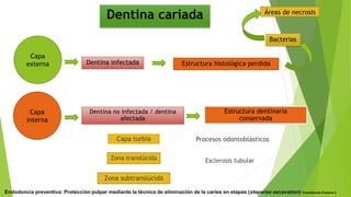 Dentina cariada
Dentina infectada Estructura histológica perdida
Áreas de necrosis
Bacterias
Capa turbia
Dentina no infectada / dentina
afectada
Estructura dentinaria
conservada
Zona translúcida
Procesos odontoblásticos
Zona subtranslúcida
Esclerosis tubular
Capa
externa
Capa
interna
Endodoncia preventiva: Protección pulpar mediante la técnica de eliminación de la caries en etapas (stepwise excavation) Castellanos-Cosano L
 