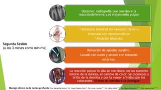 Segunda Sesión
(a los 3 meses como mínimo)
Optativo: radiografía que corrobore la
reaccióndefensiva y el alejamiento pulpar
* Anestesia terminal sin vasoconstrictor o
troncular con vasoconstrictor
* Aislación absoluto.
Remoción de apósito curativo.
Lavado con suero y secado con torundas
estériles.
La reacción pulpar in situ se corrobora por un aumento
notorio de la dureza, el cambio de color (se oscurece) y
brillo de la dentina y por la menor afinidad por los
colorantes. Si esto se corrobora se prosigue:
Manejo clínico de la caries profunda Dra. María Elia Alonso*, Dr. Hugo Calabria Díaz**, Dra. Irene Lorenzo***, Dra. Nelly Añaña****, Dra. Diana Golubchin*****, Dra. Joanna Vola******
 