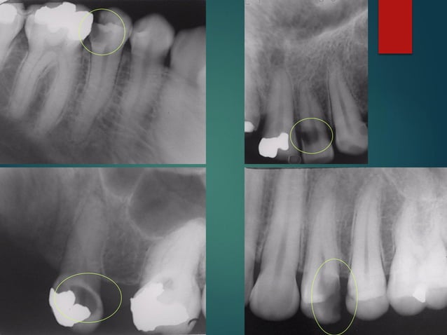 diagnostico-radiografico-de-caries-pdf
