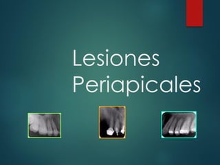 Lesiones
Periapicales
 
