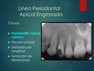 Linea Periodontal
Apical Engrosada
Causas
 Periodontitis apical
crónica
 Trauma oclusal
 Distorsión por
amplitud
 Sumación de
absorciones
 