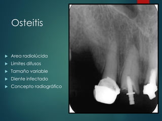 Osteitis
 Area radiolúcida
 Límites difusos
 Tamaño variable
 Diente infectado
 Concepto radiográfico
 