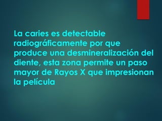 La caries es detectable
radiográficamente por que
produce una desmineralización del
diente, esta zona permite un paso
mayor de Rayos X que impresionan
la película
 