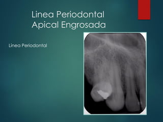 Linea Periodontal
Apical Engrosada
Línea Periodontal
 