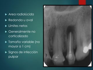  Area radiolúcida
 Redonda u oval
 Límites netos
 Generalmente no
corticalizado
 Tamaño variable (no
mayor a 1 cm)
 Signos de infección
pulpar
 