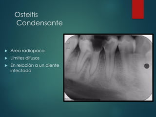 Osteitis
Condensante
 Area radiopaca
 Límites difusos
 En relación a un diente
infectado
 