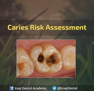 Caries Risk Assessment in Dentistry