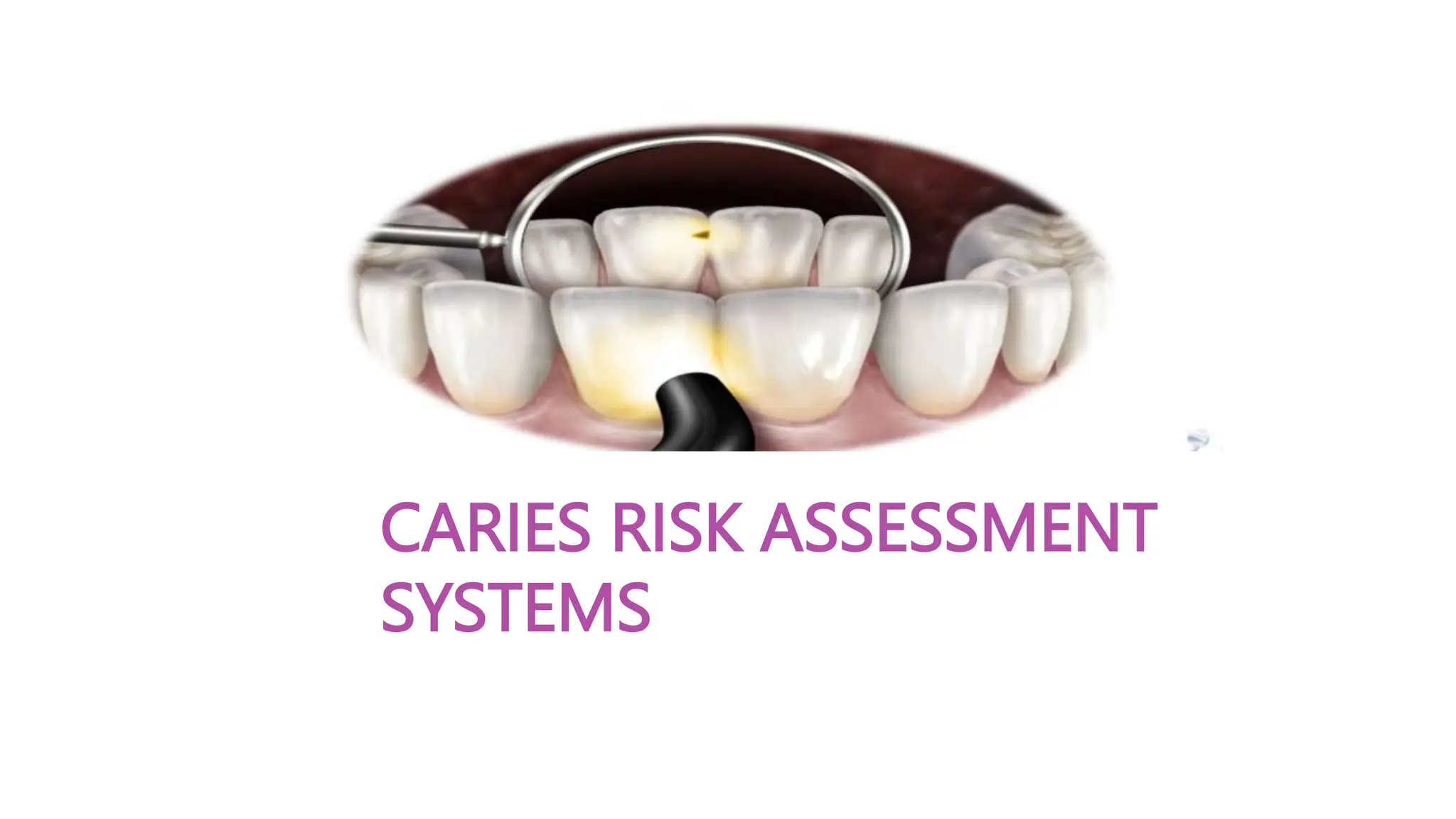 Caries risk assessment in detail description | PPTX