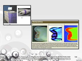 108•Mital P, Mehta N, Saini A, Raisingani D, Sharma M. RECENT ADVANCES IN DETECTION AND
DIAGNOSIS OF DENTAL CARIES. Journal of Evolution of Medical and Dental Sciences/Volume
 