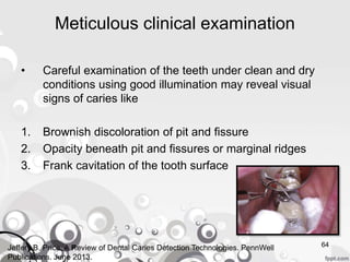 Meticulous clinical examination
• Careful examination of the teeth under clean and dry
conditions using good illumination may reveal visual
signs of caries like
1. Brownish discoloration of pit and fissure
2. Opacity beneath pit and fissures or marginal ridges
3. Frank cavitation of the tooth surface
64Jeffery B. Price. A Review of Dental Caries Detection Technologies. PennWell
Publications. June 2013.
 