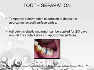 TOOTH SEPARATION
• Temporary elective tooth separation to detect the
approximal smooth surface caries.
• orthodontic elastic separator can be applied for 2-3 days
around the contact areas of approximal surfaces.
68Diniz M, Rodrigues A, Lussi A. Traditional and Novel Caries Detecion Methods. Chapter · March
2012
 