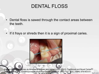DENTAL FLOSS
• Dental floss is sawed through the contact areas between
the teeth.
• If it frays or shreds then it is a sign of proximal caries.
70Michele Baffi Diniz, Jonas de Almeida Rodrigues and Adrian Lussi (2012). Traditional and Novel Caries
Detection Methods, Contemporary Approach to Dental Caries, Dr. Ming-Yu Li (Ed.), ISBN: 978-953-51-
 