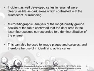 • Incipient as well developed caries in enamel were
clearly visible as dark areas which contrasted with the
fluorescent surrounding
• Microradiographic analysis of the longitudinally ground
section of the tooth confirmed that the dark area in the
laser fluorescence corresponded to a demineralization of
the enamel
• This can also be used to image plaque and calculus, and
therefore be useful in identifying active caries.
91•Mital P, Mehta N, Saini A, Raisingani D, Sharma M. RECENT ADVANCES IN DETECTION AND
DIAGNOSIS OF DENTAL CARIES. Journal of Evolution of Medical and Dental Sciences/Volume
 