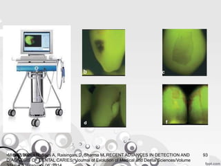 5/23/2020 93•Mital P, Mehta N, Saini A, Raisingani D, Sharma M. RECENT ADVANCES IN DETECTION AND
DIAGNOSIS OF DENTAL CARIES. Journal of Evolution of Medical and Dental Sciences/Volume
 