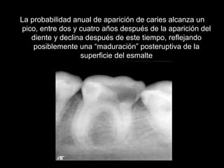 La probabilidad anual de aparición de caries alcanza un pico, entre dos y cuatro años después de la aparición del diente y declina después de este tiempo, reflejando posiblemente una “maduración” posteruptiva de la superficie del esmalte 