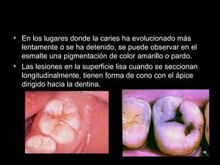 En los lugares donde la caries ha evolucionado más lentamente o se ha detenido, se puede observar en el esmalte una pigmentación de color amarillo o pardo.  Las lesiones en la superficie lisa cuando se seccionan longitudinalmente, tienen forma de cono con el ápice dirigido hacia la dentina. 