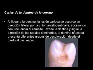 Caries de la dentina de la corona. Al llegar a la dentina, la lesión cariosa se esparce en dirección lateral por la unión amelodentinaria, socavando con frecuencia el esmalte. Invade la dentina y sigue la dirección de los túbulos dentinarios, la dentina afectada presenta diferentes grados de decoloración desde el pardo al casi negro. 