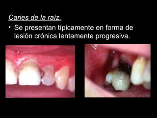 Caries de la raíz. Se presentan típicamente en forma de lesión crónica lentamente progresiva. 