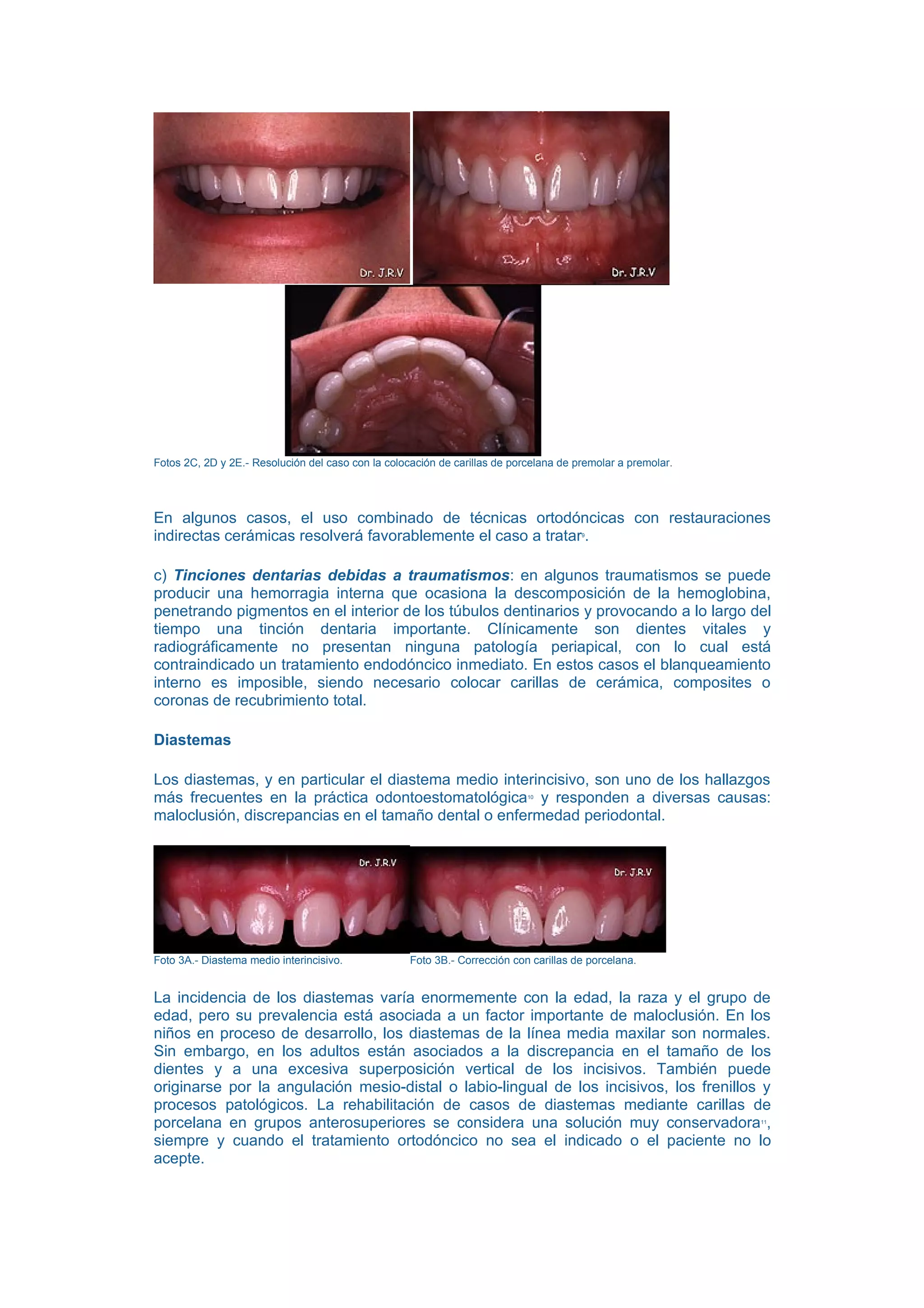 Fotos 2C, 2D y 2E.- Resolución del caso con la colocación de carillas de porcelana de premolar a premolar.




En algunos casos, el uso combinado de técnicas ortodóncicas con restauraciones
indirectas cerámicas resolverá favorablemente el caso a tratar .                       9




c) Tinciones dentarias debidas a traumatismos: en algunos traumatismos se puede
producir una hemorragia interna que ocasiona la descomposición de la hemoglobina,
penetrando pigmentos en el interior de los túbulos dentinarios y provocando a lo largo del
tiempo una tinción dentaria importante. Clínicamente son dientes vitales y
radiográficamente no presentan ninguna patología periapical, con lo cual está
contraindicado un tratamiento endodóncico inmediato. En estos casos el blanqueamiento
interno es imposible, siendo necesario colocar carillas de cerámica, composites o
coronas de recubrimiento total.

Diastemas

Los diastemas, y en particular el diastema medio interincisivo, son uno de los hallazgos
más frecuentes en la práctica odontoestomatológica y responden a diversas causas:
                                                                            10


maloclusión, discrepancias en el tamaño dental o enfermedad periodontal.




Foto 3A.- Diastema medio interincisivo.             Foto 3B.- Corrección con carillas de porcelana.


La incidencia de los diastemas varía enormemente con la edad, la raza y el grupo de
edad, pero su prevalencia está asociada a un factor importante de maloclusión. En los
niños en proceso de desarrollo, los diastemas de la línea media maxilar son normales.
Sin embargo, en los adultos están asociados a la discrepancia en el tamaño de los
dientes y a una excesiva superposición vertical de los incisivos. También puede
originarse por la angulación mesio-distal o labio-lingual de los incisivos, los frenillos y
procesos patológicos. La rehabilitación de casos de diastemas mediante carillas de
porcelana en grupos anterosuperiores se considera una solución muy conservadora ,                            11


siempre y cuando el tratamiento ortodóncico no sea el indicado o el paciente no lo
acepte.
 