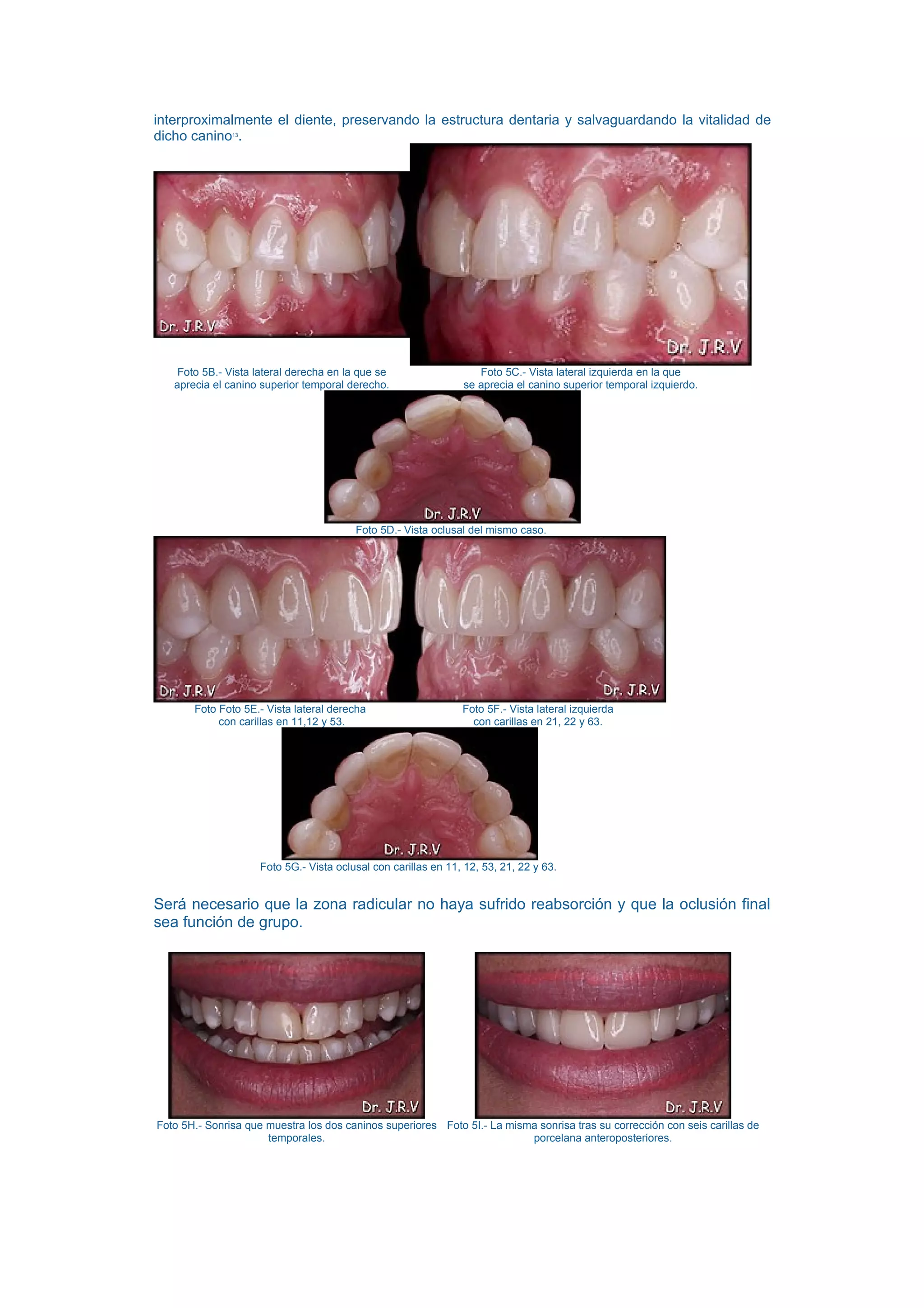 interproximalmente el diente, preservando la estructura dentaria y salvaguardando la vitalidad de
dicho canino . 13




    Foto 5B.- Vista lateral derecha en la que se                   Foto 5C.- Vista lateral izquierda en la que
   aprecia el canino superior temporal derecho.                 se aprecia el canino superior temporal izquierdo.




                                         Foto 5D.- Vista oclusal del mismo caso.




       Foto Foto 5E.- Vista lateral derecha                     Foto 5F.- Vista lateral izquierda
            con carillas en 11,12 y 53.                           con carillas en 21, 22 y 63.




                     Foto 5G.- Vista oclusal con carillas en 11, 12, 53, 21, 22 y 63.


Será necesario que la zona radicular no haya sufrido reabsorción y que la oclusión final
sea función de grupo.




Foto 5H.- Sonrisa que muestra los dos caninos superiores Foto 5I.- La misma sonrisa tras su corrección con seis carillas de
                      temporales.                                         porcelana anteroposteriores.
 