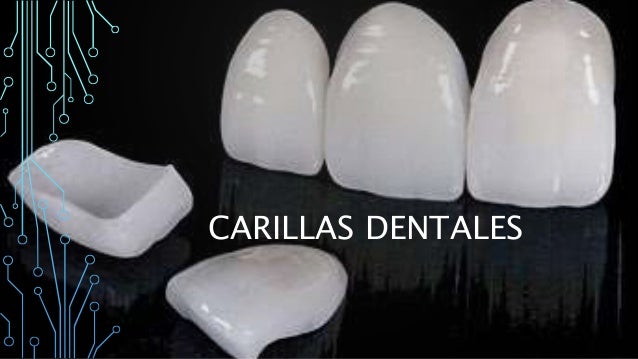 carillas dentales