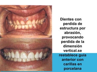 CLASIFICACION

       METODO           CONFECCION           MATERIAL


Directo             • Sobre el diente   • Resina co...