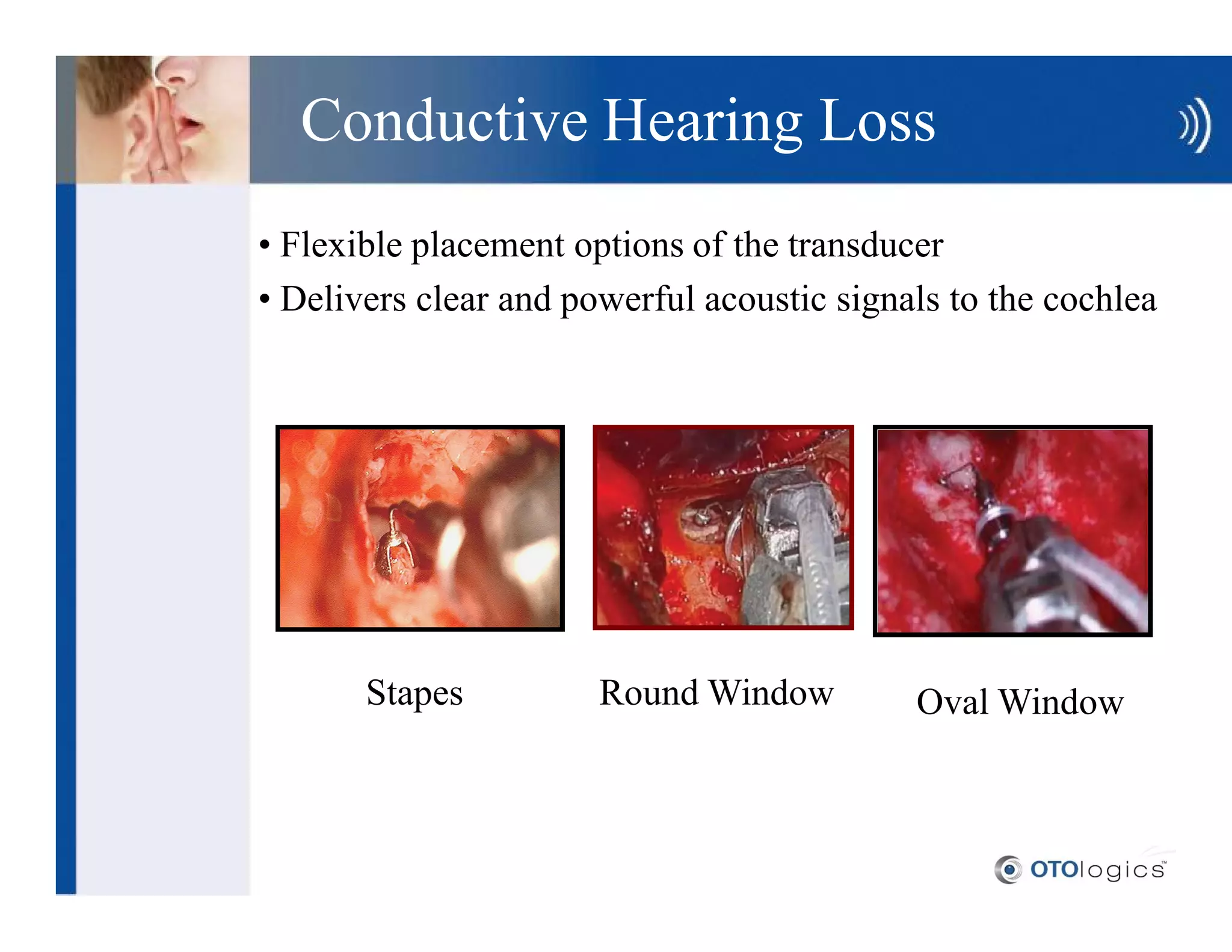 Conductive Hearing Loss
Flexible placement options of the transducer
Delivers clear and powerful acoustic signals to the cochlea




     Stapes          Round Window         Oval Window
 