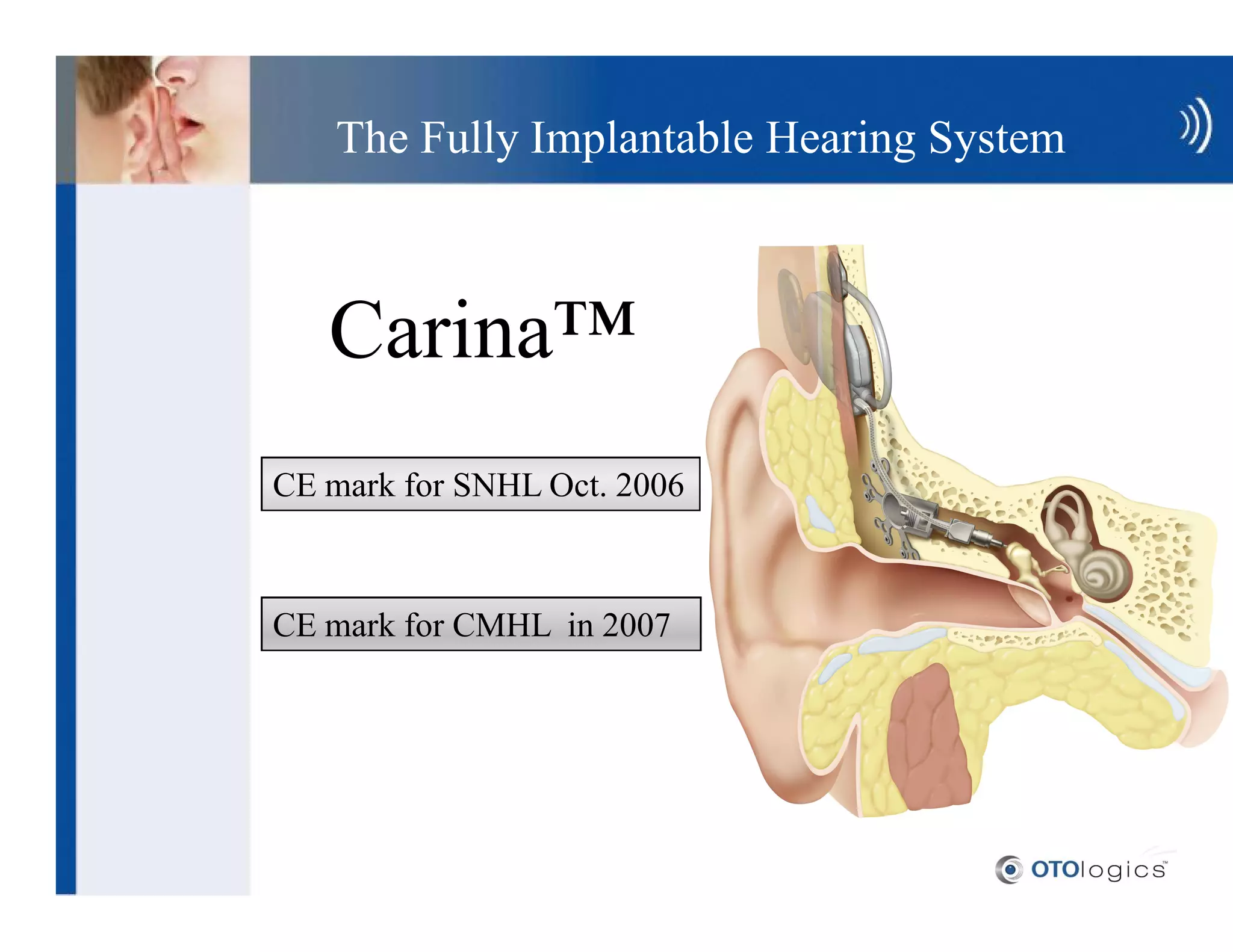 The Fully Implantable Hearing System



   Carina
CE mark for SNHL Oct. 2006



CE mark for CMHL in 2007
 