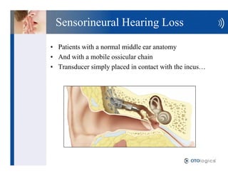 Sensorineural Hearing Loss

Patients with a normal middle ear anatomy
And with a mobile ossicular chain
Transducer simply ...