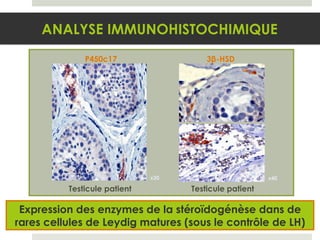 Expression des enzymes de la stéroïdogénèse dans de rares cellules de Leydig matures (sous le contrôle de LH) ANALYSE IMMUNOHISTOCHIMIQUE x40 P450c17 Testicule  patient 3 β -HSD x20 Testicule  patient 