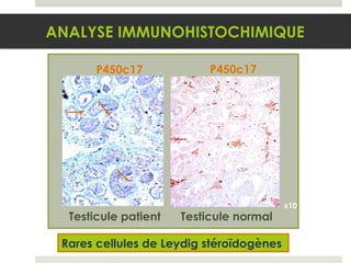 Rares cellules de Leydig stéroïdogènes  ANALYSE IMMUNOHISTOCHIMIQUE x10 P450c17 Testicule  patient Testicule  normal P450c17 