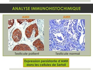 Expression persistante d’AMH dans les cellules de Sertoli ANALYSE IMMUNOHISTOCHIMIQUE Testicule  patient AMH Testicule  normal AMH 