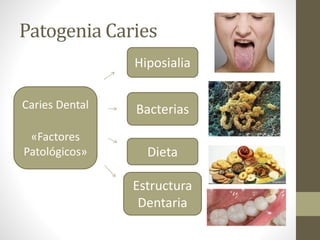 Patogenia Caries
Caries Dental
«Factores
Patológicos»
Estructura
Dentaria
Dieta
Bacterias
Hiposialia
 