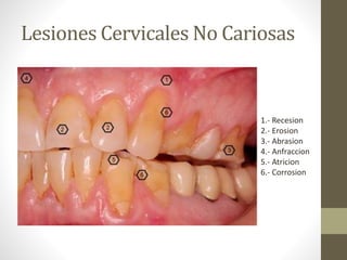 Lesiones Cervicales No Cariosas
1.- Recesion
2.- Erosion
3.- Abrasion
4.- Anfraccion
5.- Atricion
6.- Corrosion
 