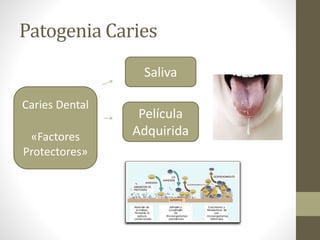 Patogenia Caries
Caries Dental
«Factores
Protectores»
Película
Adquirida
Saliva
 