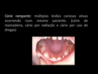 Cárie rampante: múltiplas lesões cariosas ativas
ocorrendo num mesmo paciente. (cárie de
mamadeira, cárie por radiação e cárie por uso de
drogas)
 