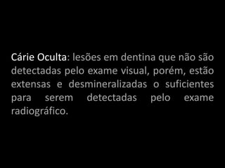 Cárie Oculta: lesões em dentina que não são
detectadas pelo exame visual, porém, estão
extensas e desmineralizadas o suficientes
para serem detectadas pelo exame
radiográfico.
 